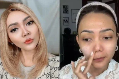 Rina Nose Ungkap Post-Op Blues dan Keputusan Childfree: Kisah Emosional di Balik Operasi Hidung