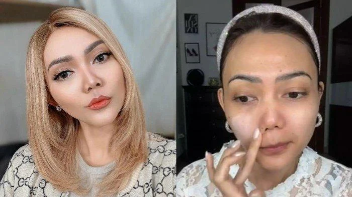 Rina Nose Ungkap Post-Op Blues dan Keputusan Childfree: Kisah Emosional di Balik Operasi Hidung